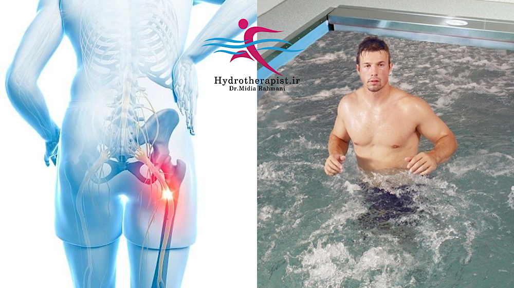 سیاتیک در جوانان و درمان آن با آبدرمانی